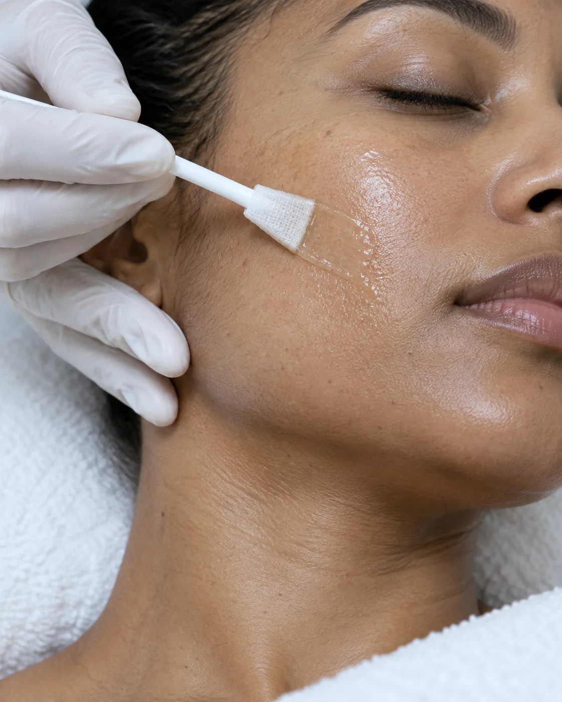 Gloved hand applying a clear solution to a woman’s cheek with a gauze applicator